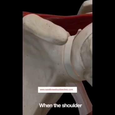 3D medical animation explaining Bankart tear and arthroscopic Bankart repair of the shoulder
