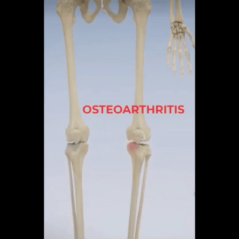 3D educational animation of knee osteoarthritis and High Tibial Osteotomy leg alignment correction