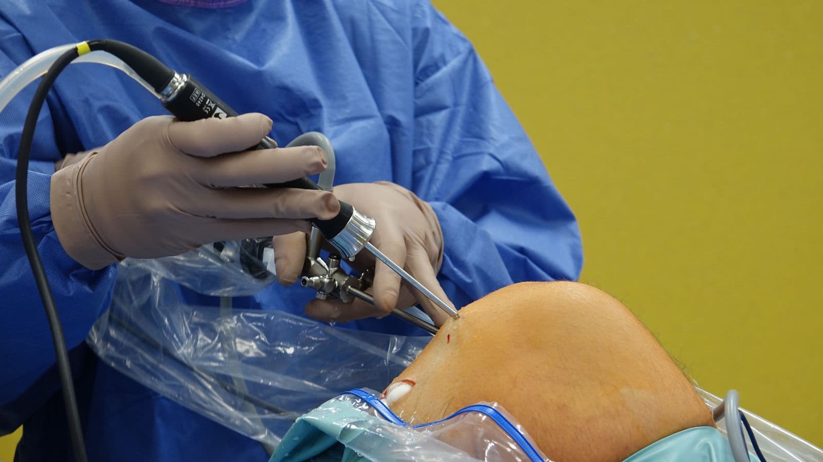 ACL Reconstruction by Dr. Manish Saini in Surat